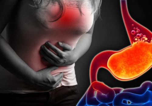 Comprehensive Approach to Acid Reflux & GERD Management